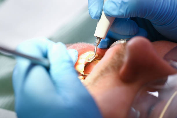 Best Dental Abscess Treatment in Pandora, OH